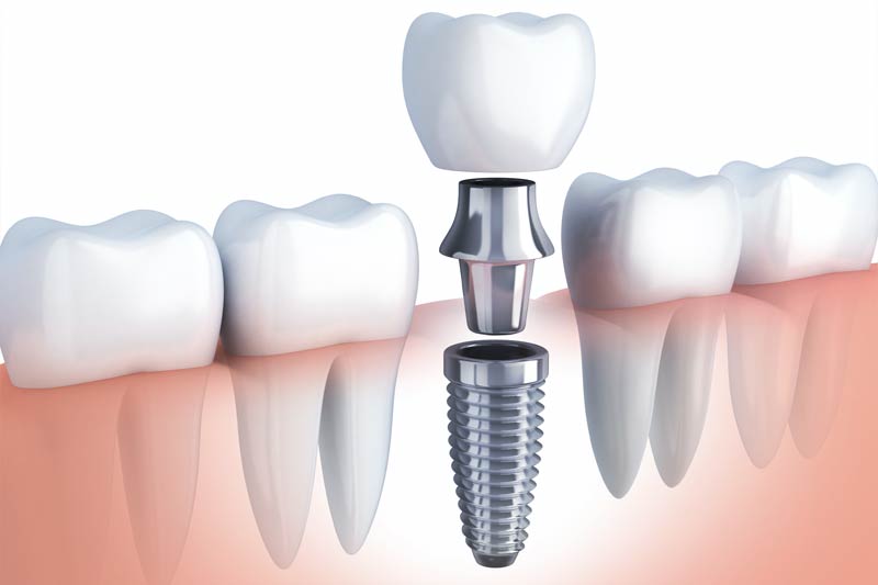 Emergency Dentist in Las Vegas